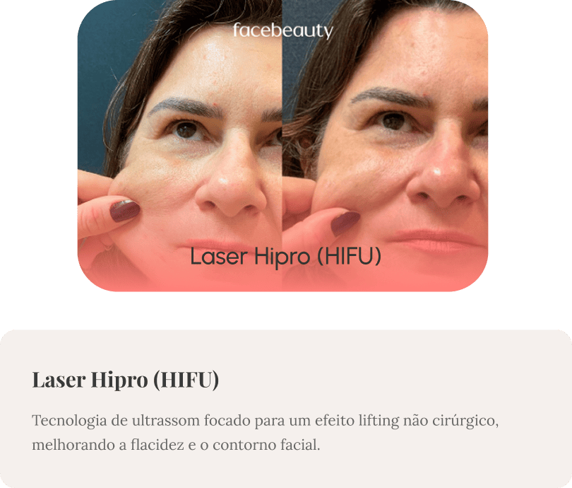 HIFU