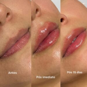 preenchimento-labial-2.jpg