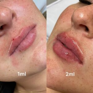 preenchimento-labial-3.jpg